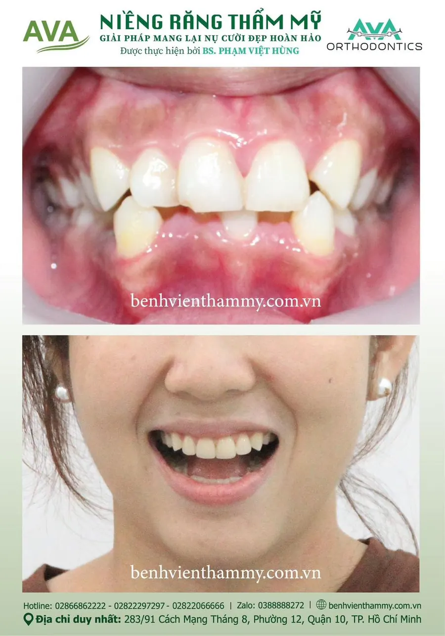 Hình ảnh trước và sau khi niềng răng trả góp quận 10 TPHCM tại Nha khoa AVA