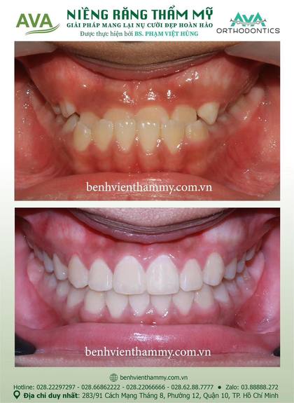 Ca niềng răng trả góp tphcm trước và sau điều trị tại Nha khoa AVA, ca 01