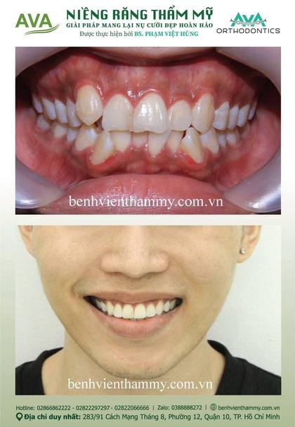 Hình ảnh trước và sau khi niềng răng – niềng răng trả góp quận 10 tại Nha khoa AVA, ca 05