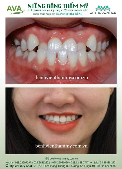 Kết quả niềng răng TPHCM trước và sau tại Nha khoa AVA Quận 10, ca 06