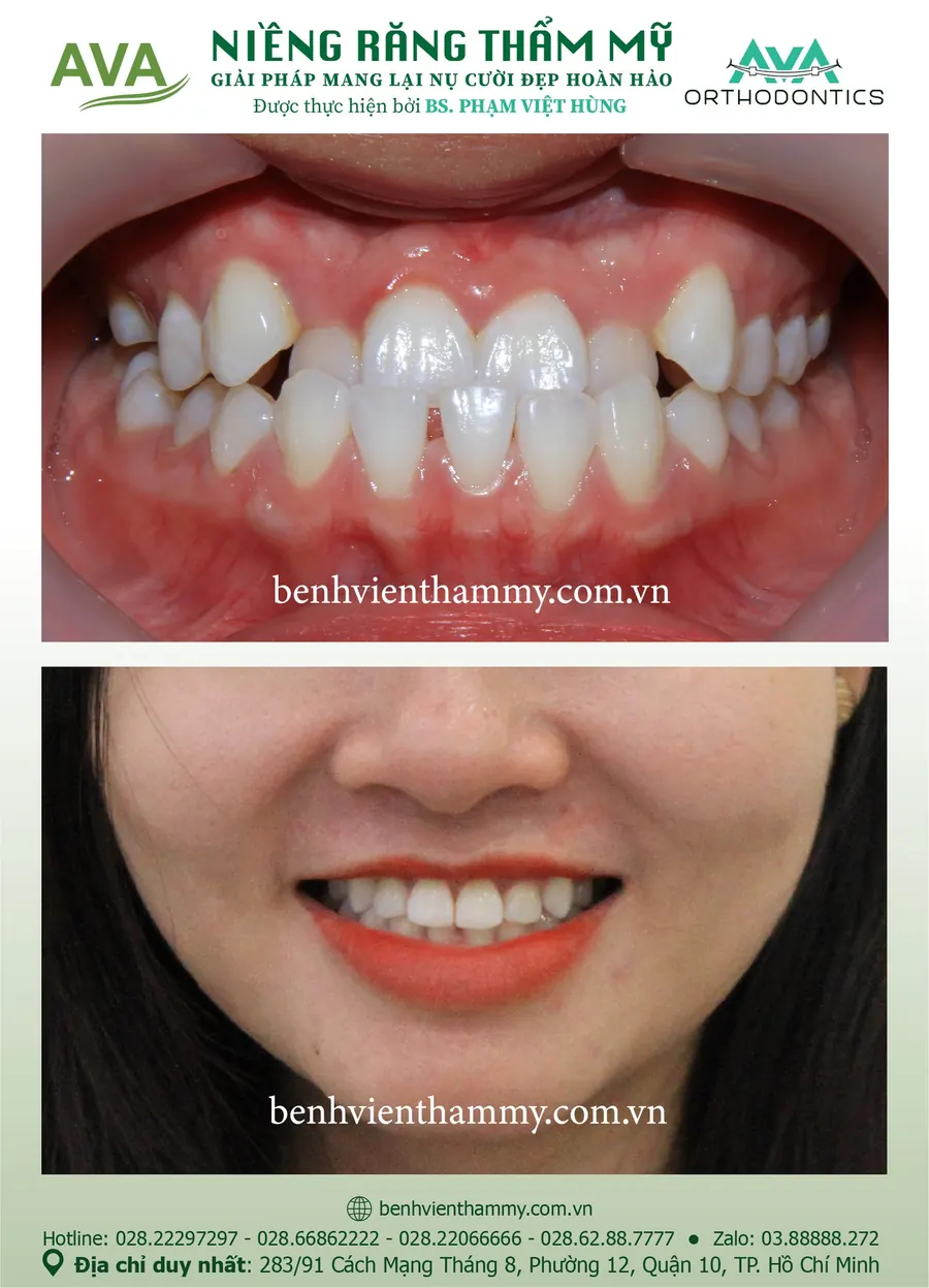Một ca niềng răng thực tế trước và sau tại Nha khoa AVA, Quận 10, TPHCM